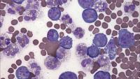 PEL Giemsa 400X - Hematopathology at Department of Pathology and Cell Biology CUMC
